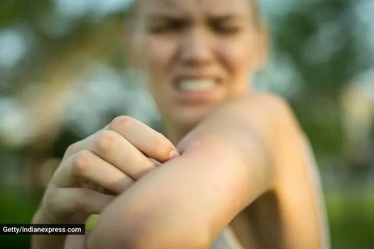 picadura de mosquito, imán para mosquitos